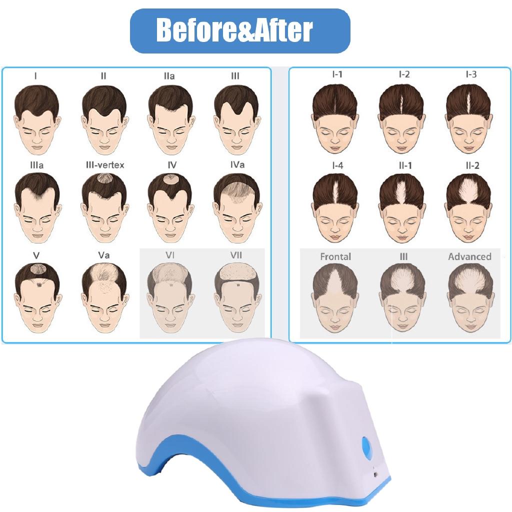 100-240V 50/60Hz Rechargeable Laser Hair Regrowth Helmet 678nm Hair Low Light Extension Laser Cap Treating Hair Loss