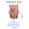 Human Pathologies of Rectum Model Medicals Teaching Tool Human Rectum Model Human Anatomy Model Teaching Supplies
