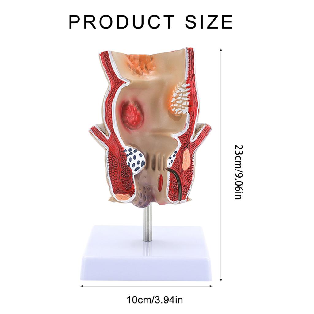 Human Pathologies of Rectum Model Medicals Teaching Tool Human Rectum Model Human Anatomy Model Teaching Supplies