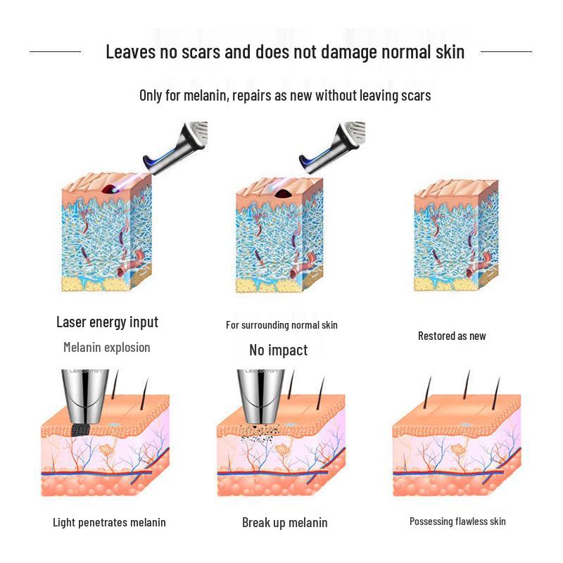 Portable Picosecond Laser Pen for Tattoo, Freckle, and Eyebrow Removal with Red & Blue Light