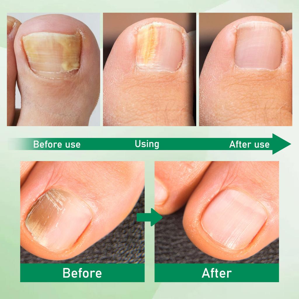 Nail Care Ball Stick Daily Cleanses Hands, Feet, Nails, Soft Nails And Gentle Nourishing Nails Stick 5ml