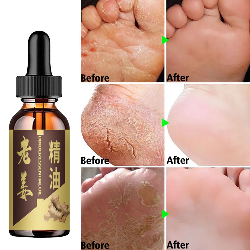 Relieve Foot Odor and Itching with Natural Essential Oils