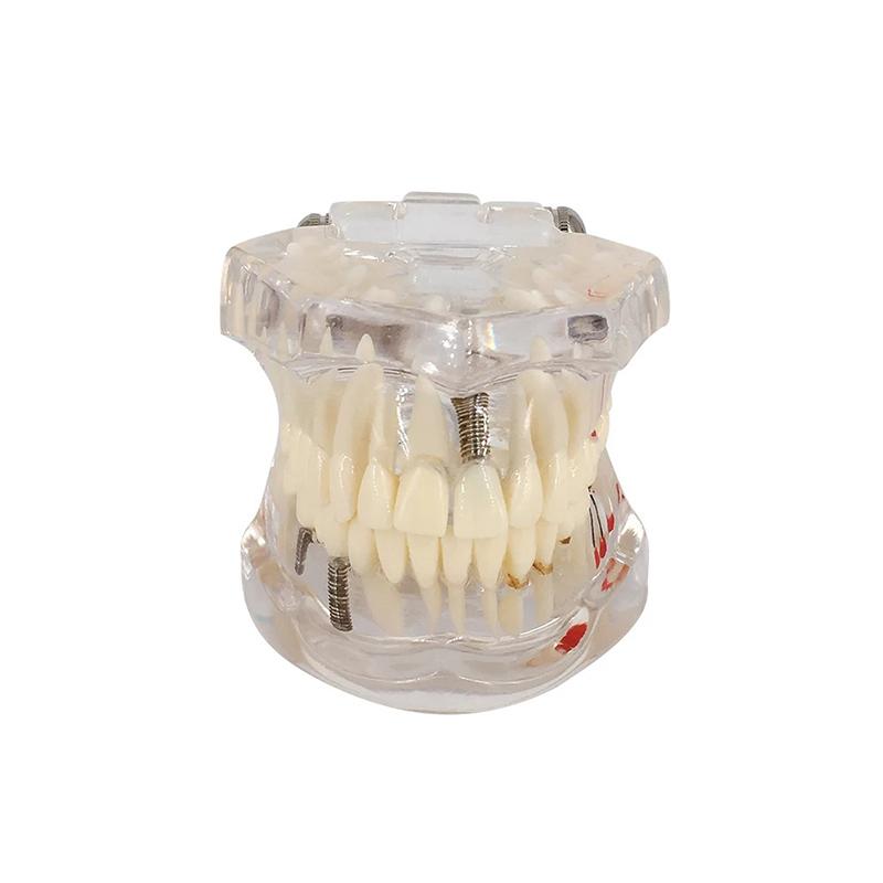 

Съемная модель зубов Имплант Заболевание Стоматолог Изучение Новая стоматологическая модель Зубы Имплант Реставрация Мост Обучение Демонстрация прозрачный