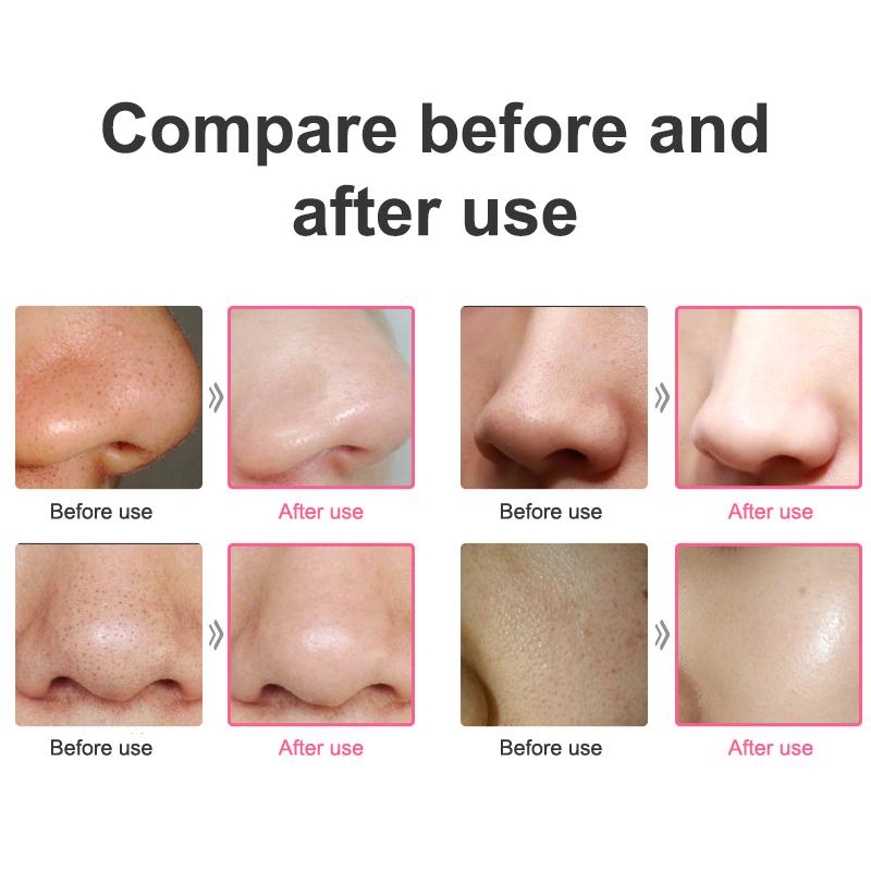 Multi-Functional Cleaning Blackhead Remover Pore Acne Pimple Removal Face T Zone Nose Cleaner Vacuum Suction Facial Beauty Devi
