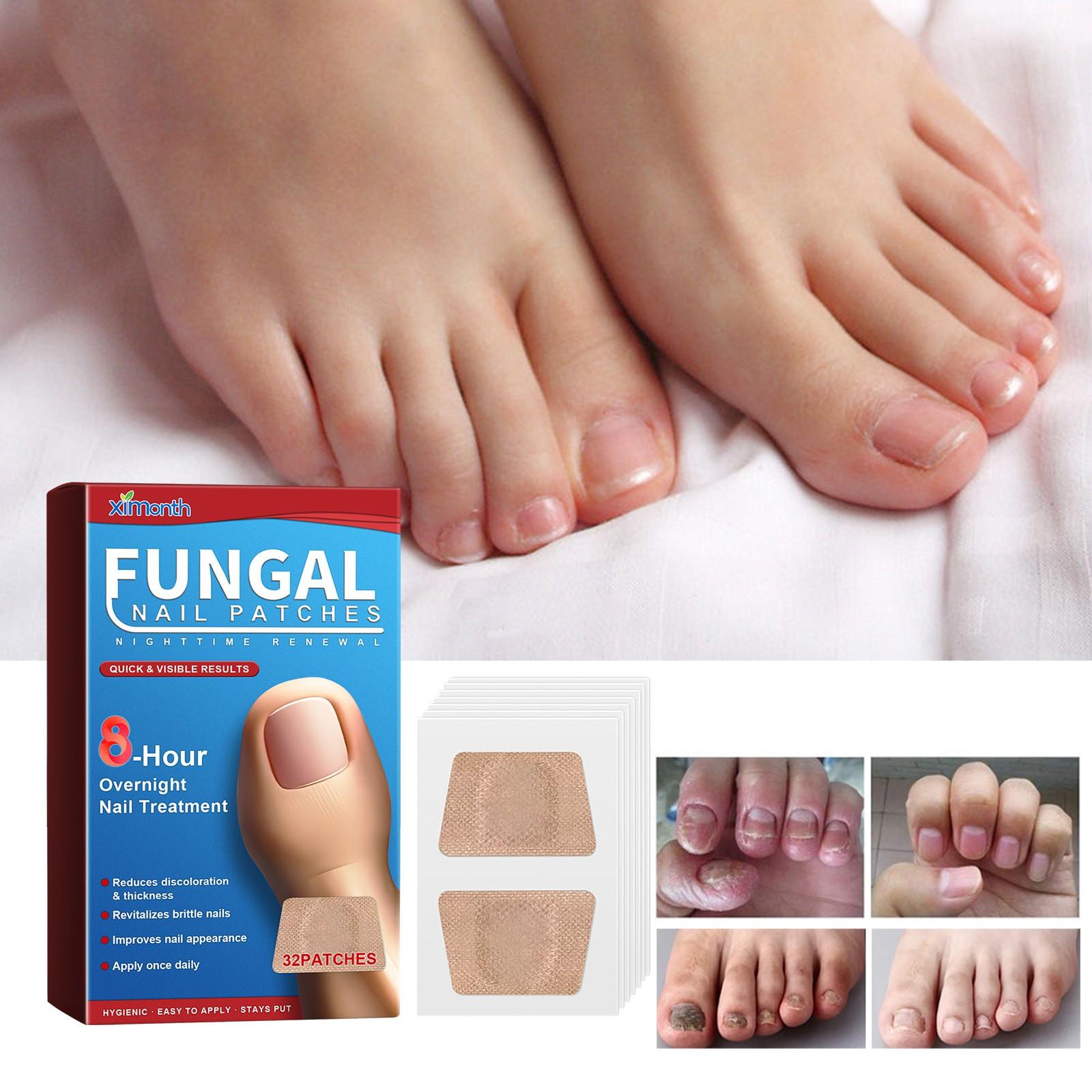 

Пластыри для ухода за ночными ногтями Пластыри для ухода за ногтями Пластыри для ухода за утолщенными ногтями Вросшие ногти и мягкие ногти Пластыри для ухода за ногтями One Size