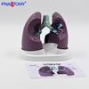 Human Lung Model: Healthy vs. Smoking Lesion for Respiratory Teaching