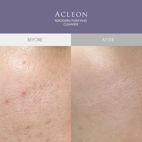 Acleon Anasis Mildly Alkaline Mildly Acidic Foam Cleansing 200ml