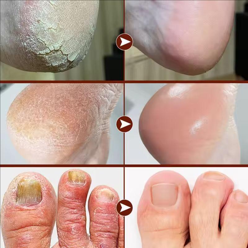 Bee Venom Foot Cream Deeply Cleanses the Feet, Prevents Dryness and Cracking, Effectively Moisturizes Dry Skin, and Prevents Peeling.