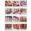 3ml Nail Problem Treatment of Onychomycosis Repair 1 Bottle Bacteriostat  5 Bottles for 30 Days