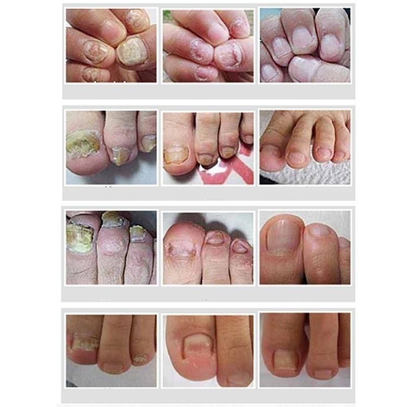 3ml Nail Problem Treatment of Onychomycosis Repair 1 Bottle Bacteriostat  5 Bottles for 30 Days