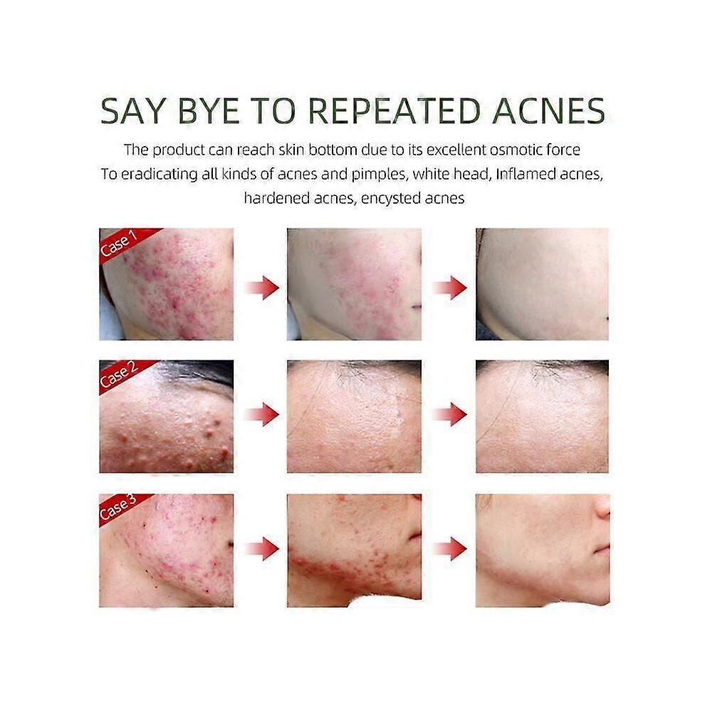 3Pcs JoyPretty Herbal Acne Removal Face Cream Against Pimple Remover Ance Treatment Anti Ance Moisturizing Repair Damage Skin Care