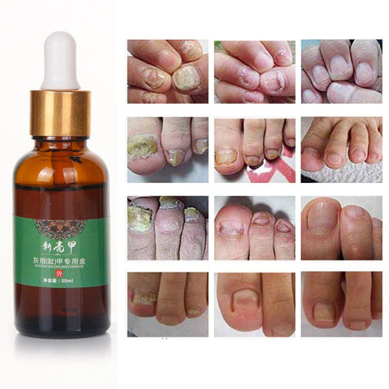 Buy 30ml Onychomycosis Fungal Treatment Nail Treatment Feet Care