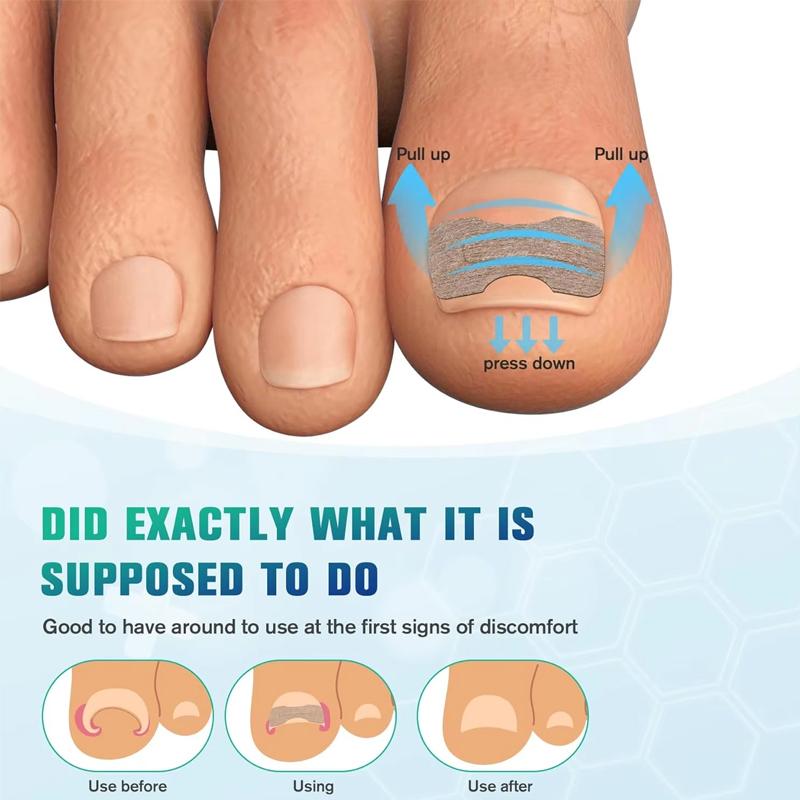 Nail Correction Stickers Ingrown Toenail Corrector Patches Paronychia Treatment Recover Corrector Pedicure Tools