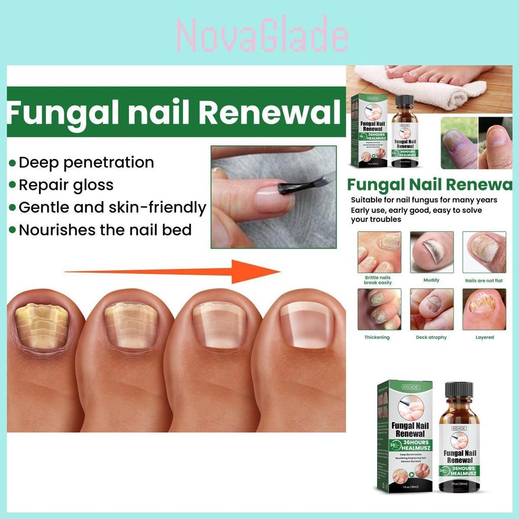 Eelhoe Nail Care Solution For Fungal Toenail Treatment With Nourishing Moisture