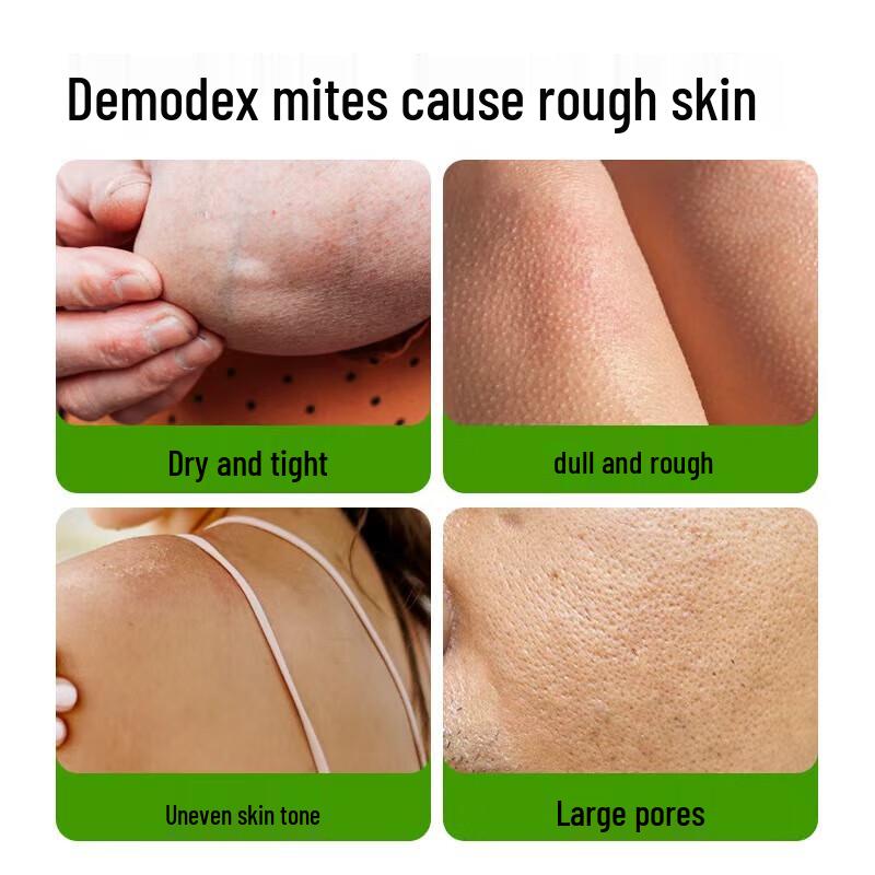 MANTING Anti-Mite Nourishing Soap