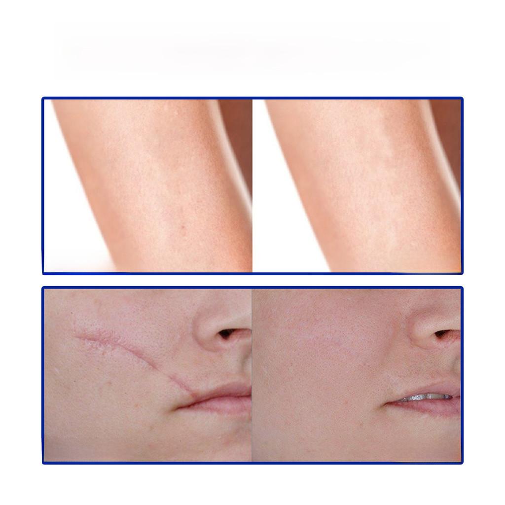 South Moon Scar Healing Gel With Soothing Formula For Burns Surgical Scars And Keloids