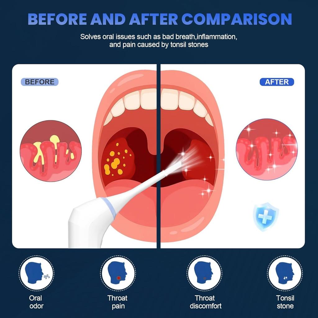 Electric Tonsil Stone Remover – Gentle Precise and Safe Removal with 3-Type Adjustable Suction & LED Light – Food-Grade Material,Rechargeable
