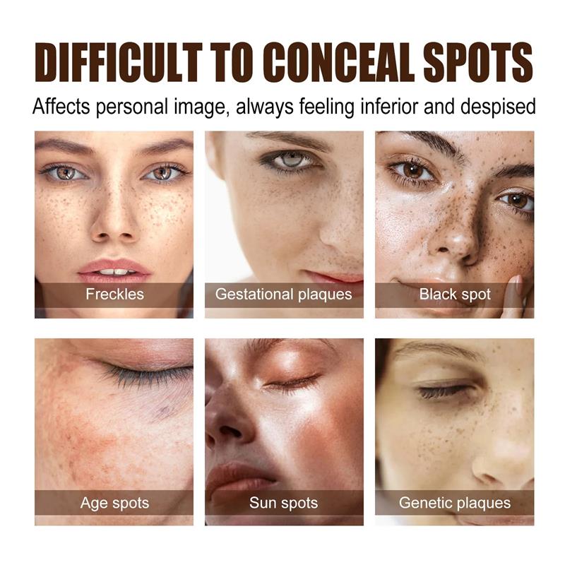 Powerful Spot-Removing Whiten Cream Brighten Skin Fast Eliminates Melanin Pigmentation Melasma Dark Spots