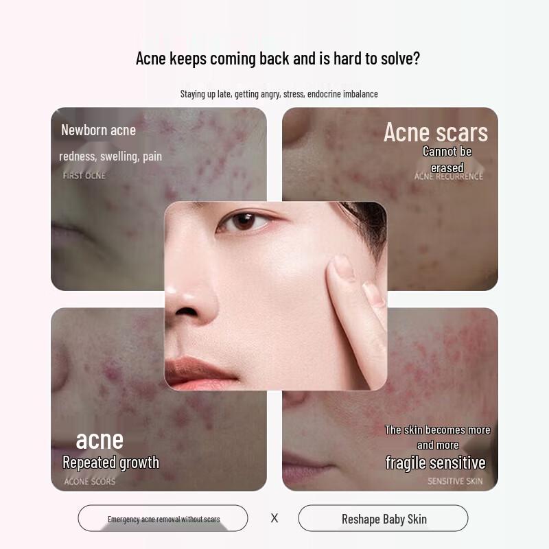 Anqisheng 15% Azelaic Acid Acne Treatment Gel