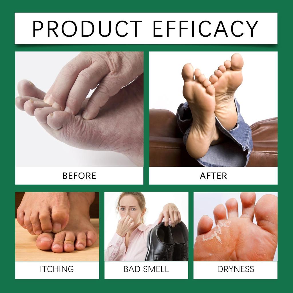 Foot Exfoliating Spray 30ml, Removes Dead Skin, Moisturizes, Softens Calluses, Smoothes Skin, Foot Care Spray