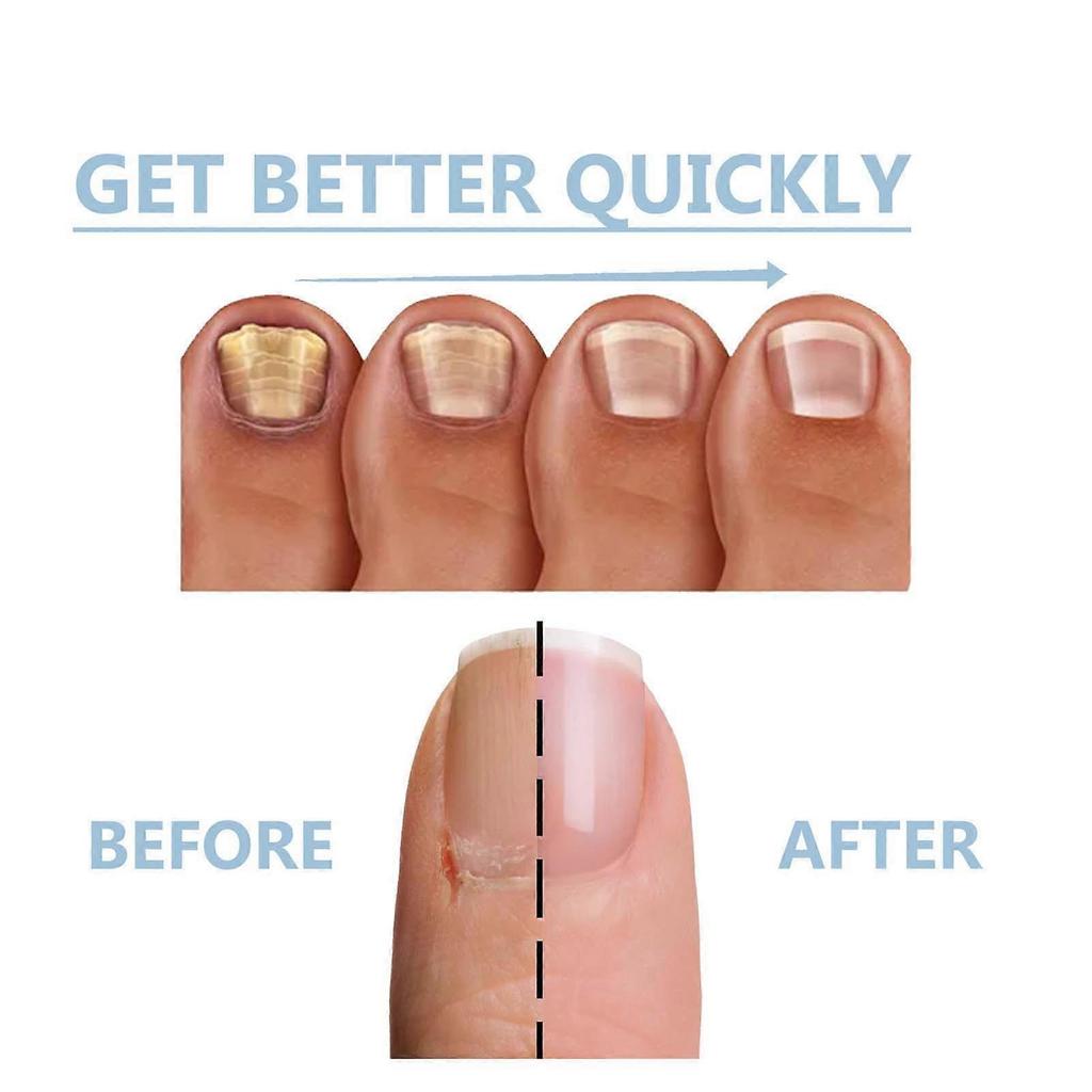 Ingrown Nail Repair Solution Safe Painless Anti-Fungal Toe Care Serum for Men & Women Nail Fungus Treatment 15ml