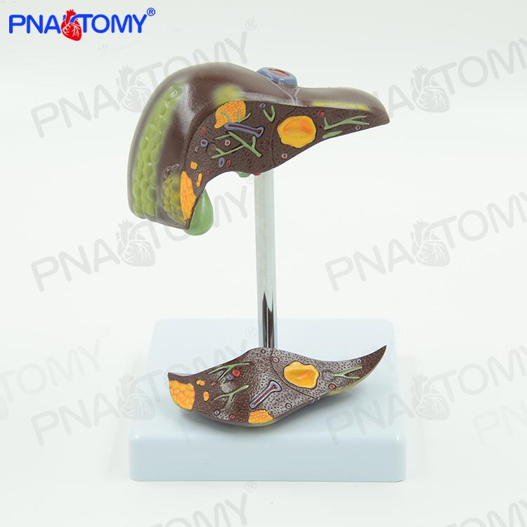 Smoking-Induced Liver Pathology and Gallbladder Model for Gastroenterology Education 11x11x15 cm