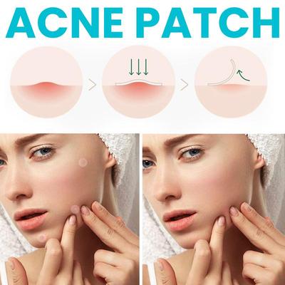 Acne Patch Repair Facial Acne Invisible Concealer Hydrocolloid Patch
