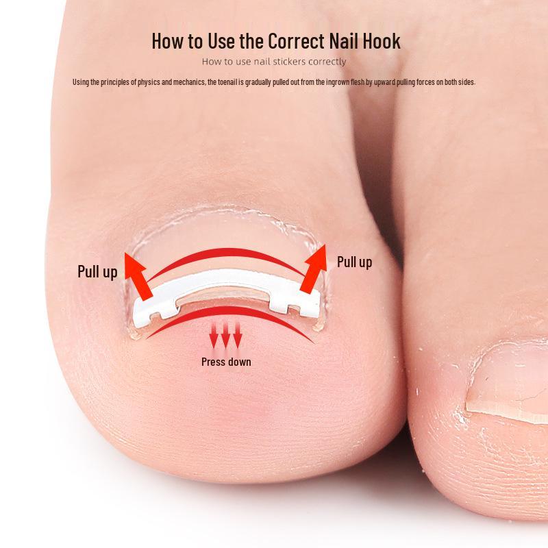 Nickel-Titanium Ingrown Toenail Corrector: Invisible, Wearable Nail Hook for Pain Relief