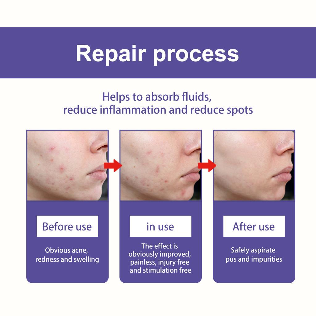 Wiieey Moon Pimple Patches For Diminishing Acne Marks And Concealing Blemishes 144pcs