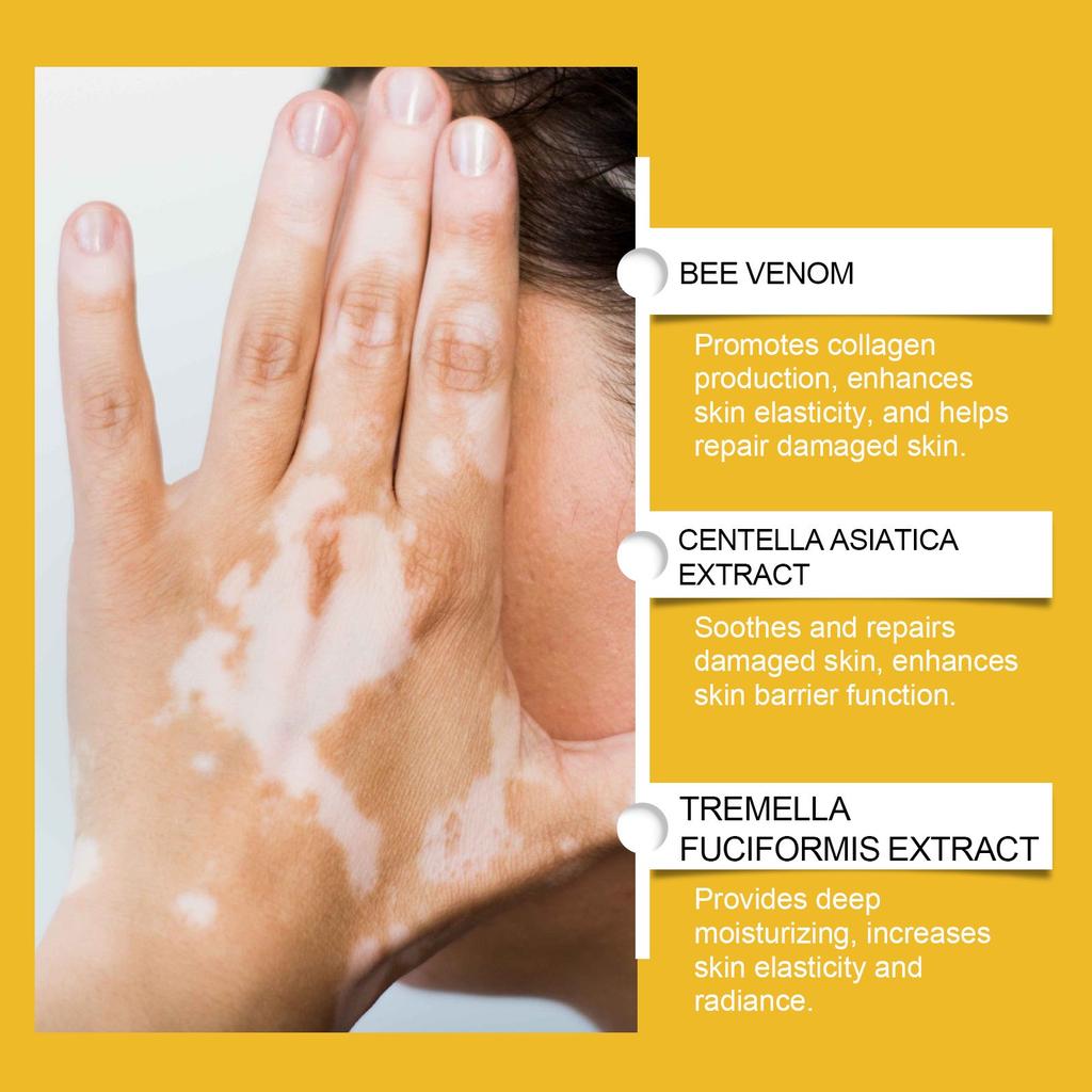 Vitiligo Relief Cream, Skin Care Cream, Vitiligo Cream, Improves Dryness, Suitable For All Skin Types