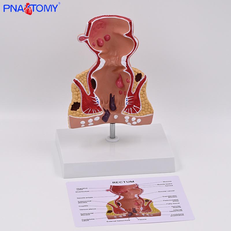 Human Rectal Anatomy Model - Pathology Teaching Aid PNT-0777
