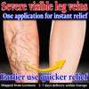 Herbal Varicose Veins Cream - Eases Aching Legs Gentle Non-Irritating