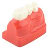 1pc Resin Dental Demonstration Tooth Model Implant Analysis Crown Bridge for Dentist
