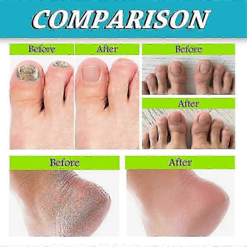 3 pezzi Spray per Piedi e Unghie, Cura dei Piedi Naturale e Potente