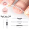 Double-Wing Ni-Ti Alloy Bionic Bone Patch for Ingrown Toenail Correction
