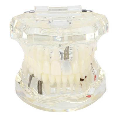 Transparent Disease Teeth Model Laboratory Pathological Anatomy Study Teaching Tooth Model