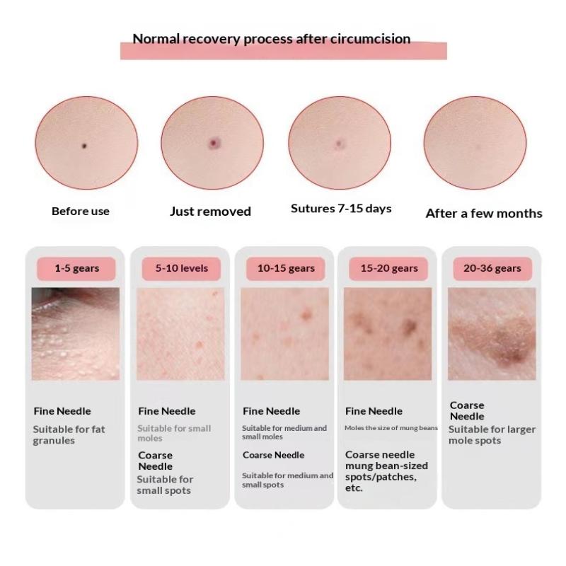 1 Set Remove Dark Mole Face Cleaner Skincare Tool 220V Electronic Spot Scanner Dead Skin Removal Beauty Device Blackhead Remover