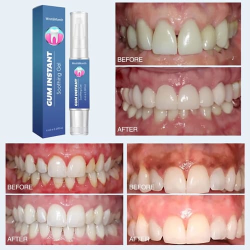 Gum Care Gel for Recessed Gums, Gum Therapy Gel, Teeth Whitening Essence Pen, Natural Ingredients, Non-Abrasive, Gum Care Gel, 16g/4ml, Prevents Perio