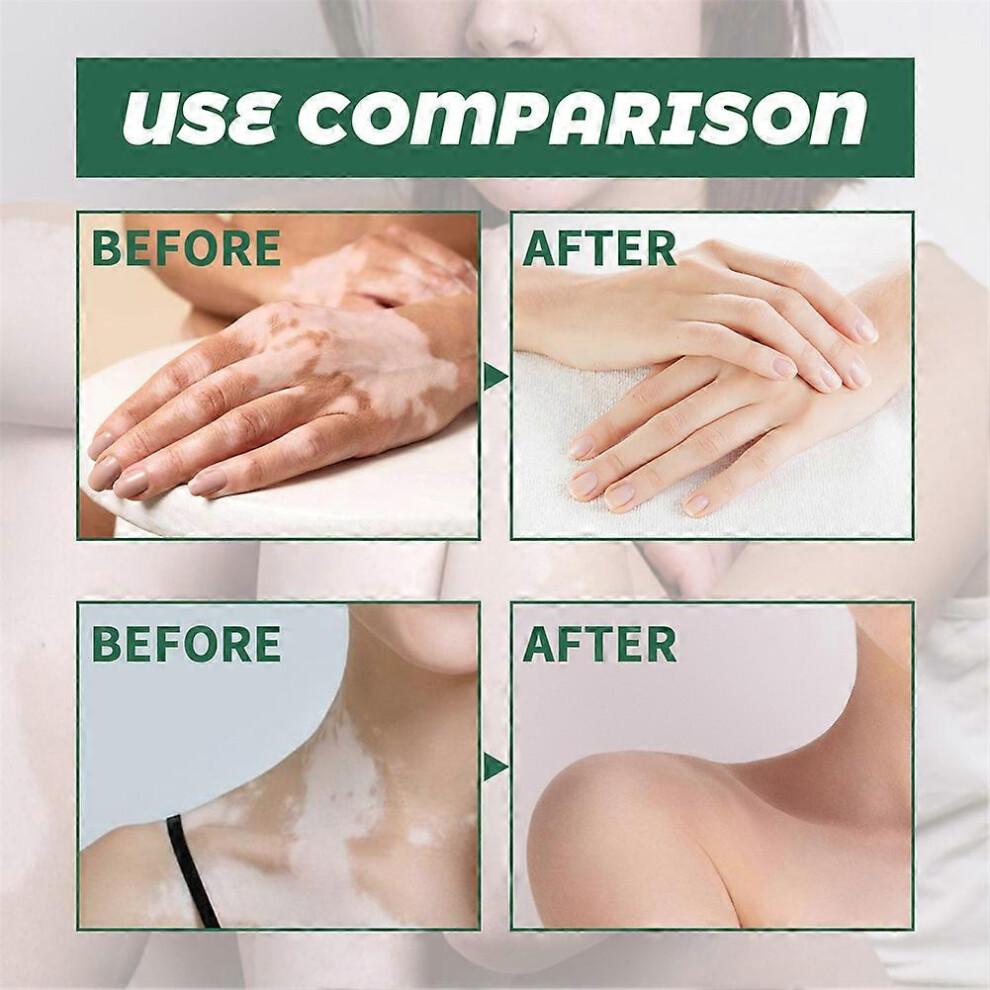 2 uds. Crema Reparadora de Piel para Vitíligo, Crema Tratamiento Vitíligo, Elimina Manchas Blancas en la Piel y Mejora la Pigmentación de la Piel