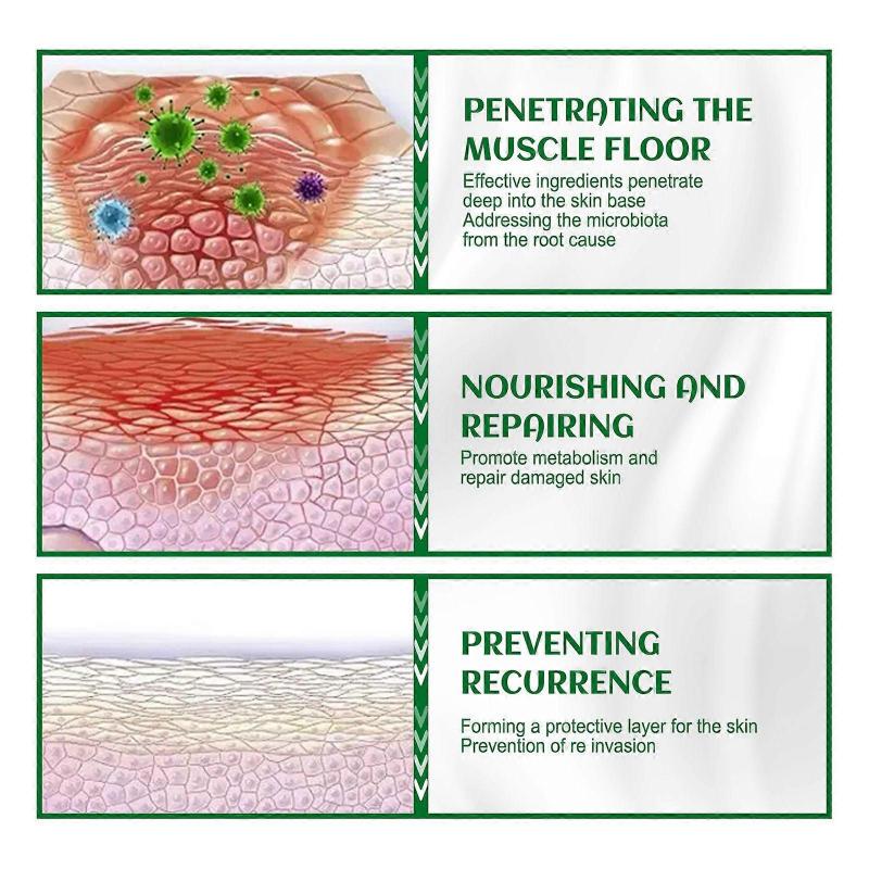 3PCS Hair Follicle Cream Treat Scalp Hair Folliculitis Skin Inflammation Spot Remover Body Acne Anti Itching Ointment