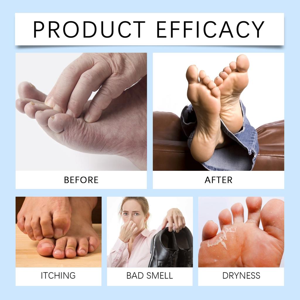 Athlete's Foot Spray Foot Sprays, Foot Care Sprays, Athlete's Foot Foot Odor, Relieves Itching, Peeling, Sweating, Blisters And Inflammation,60ML