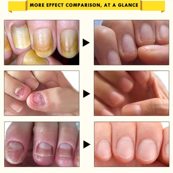 OEDO Nail Treatment Essence Oil Moisturizing Fungus Removal Foot Care Liquid