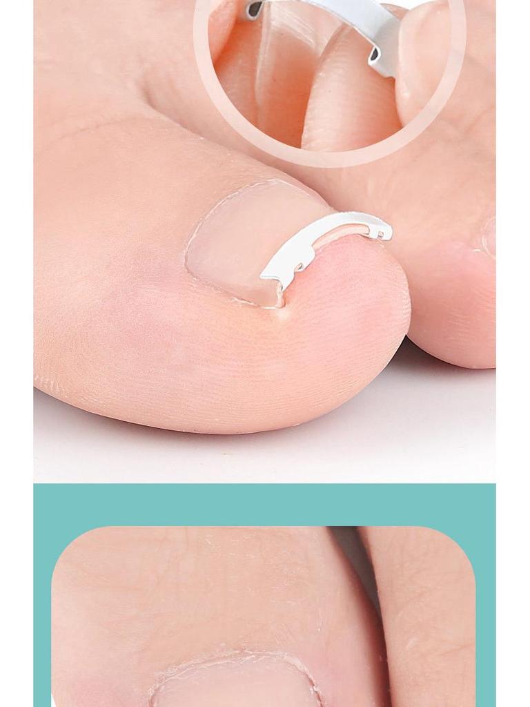 Nickel-Titanium Ingrown Toenail Corrector: Invisible, Wearable Nail Hook for Pain Relief