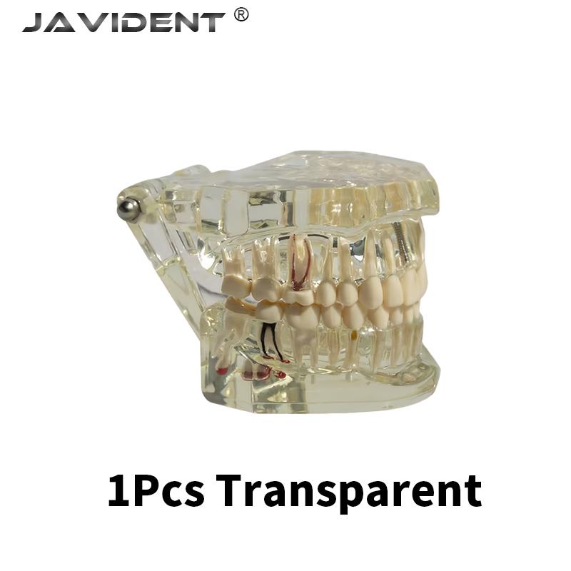 1Pcs Dental Implant Models, Oral Pathology Models, Comprehensive Dental Teaching Models, Fixed Bridge and Veneer Restorations