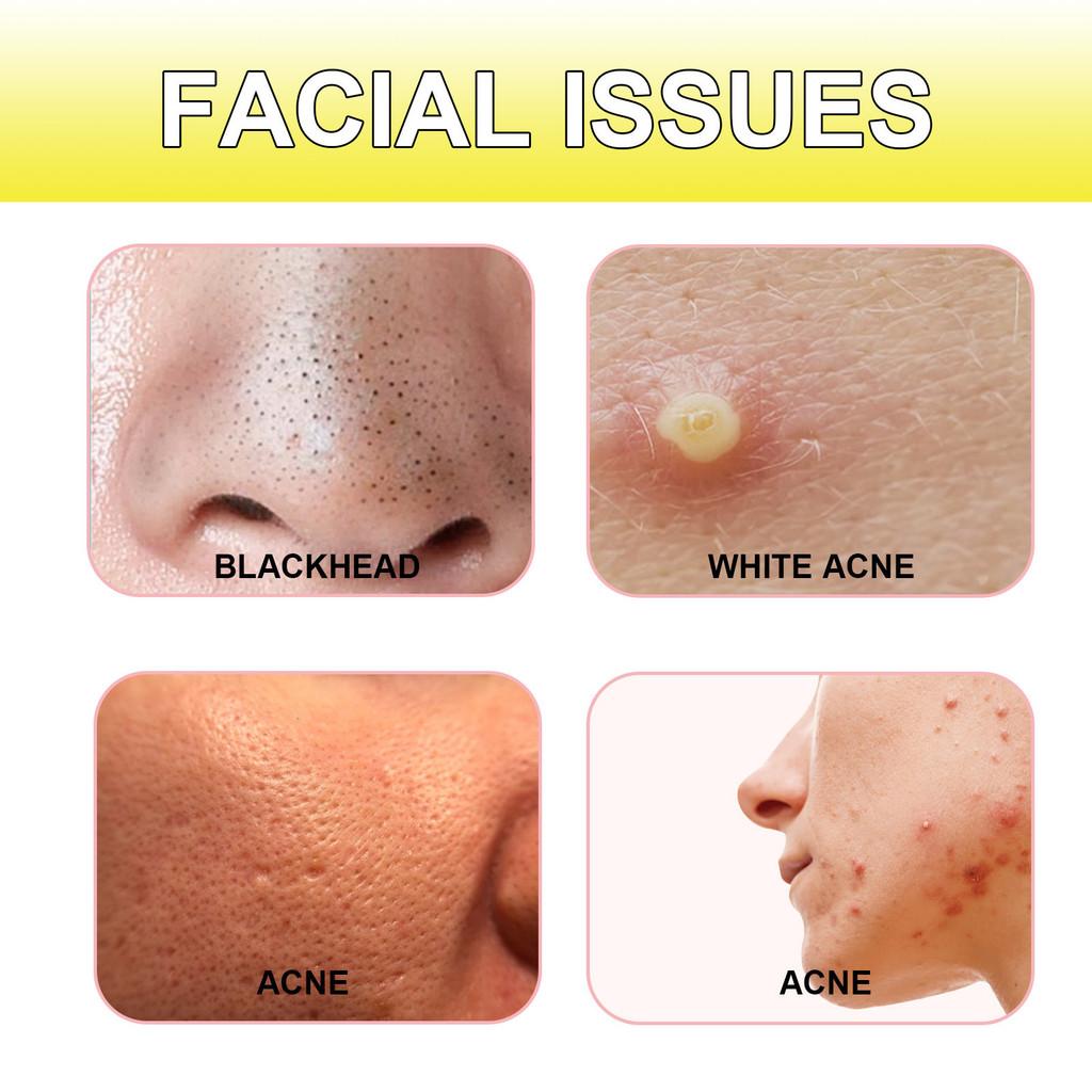 Jaysuing Acne Patches For Clear Skin 20pcs Effective Blackhead Removal Treatment