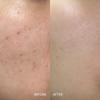 Acleon Acne Cleansing + Pore Ampule 15ml