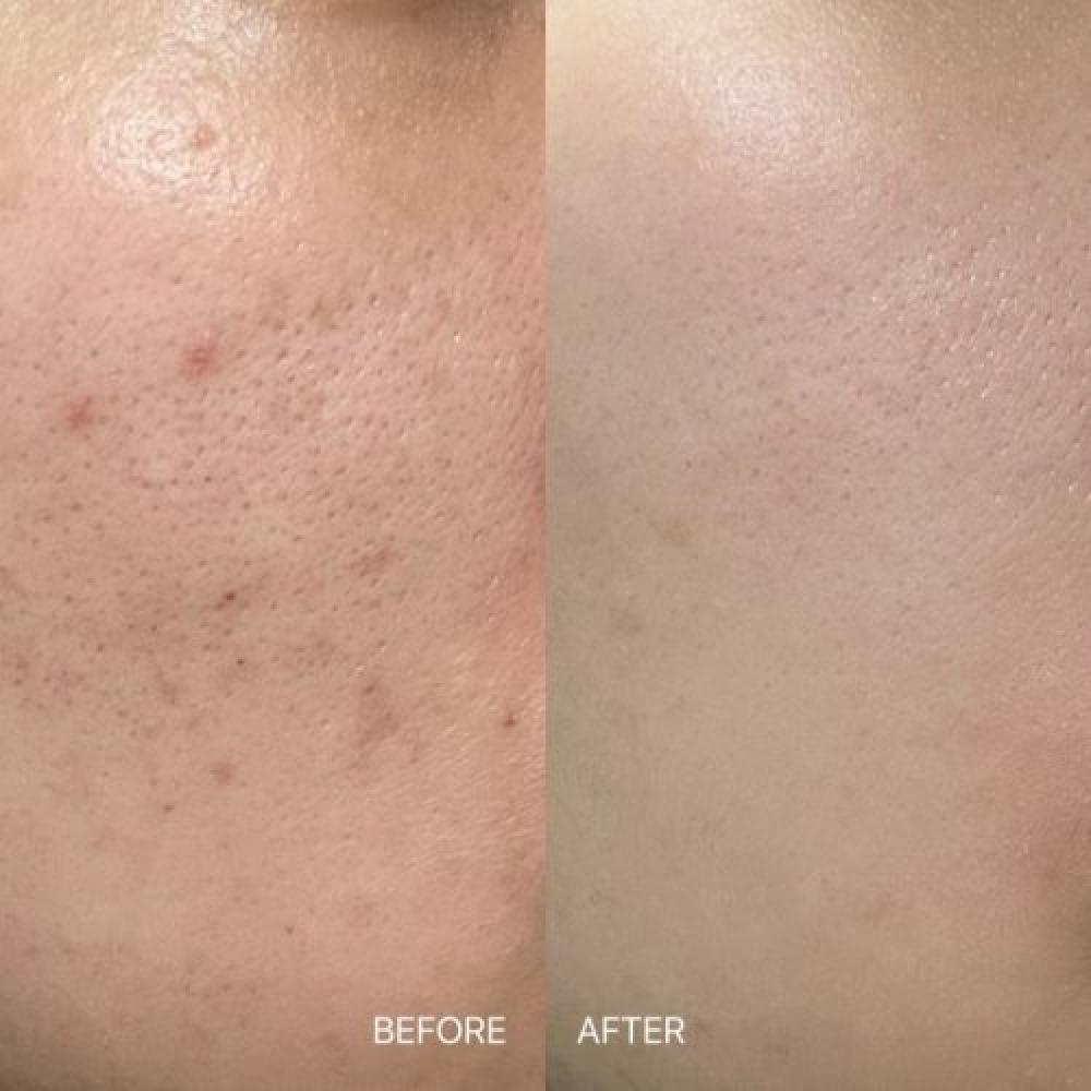 Acleon Acne Cleansing + Pore Ampule 15ml