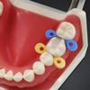 40 stücke/80 stücke/120 stücke Dental Elastische Gummi Befestigung Keile Interdental Keile Autoklavierbar Matrix Matrizen