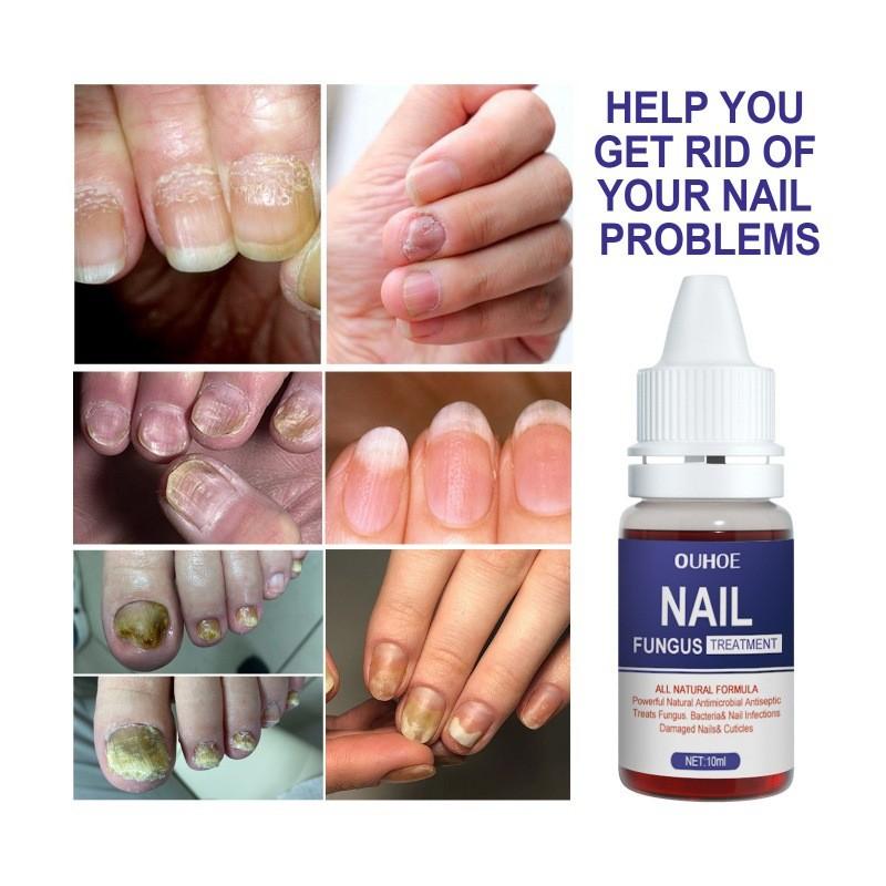 Ouhoe Nail Repair Solution Thickening Treatment For Ingrown Nails And Fungal Issues