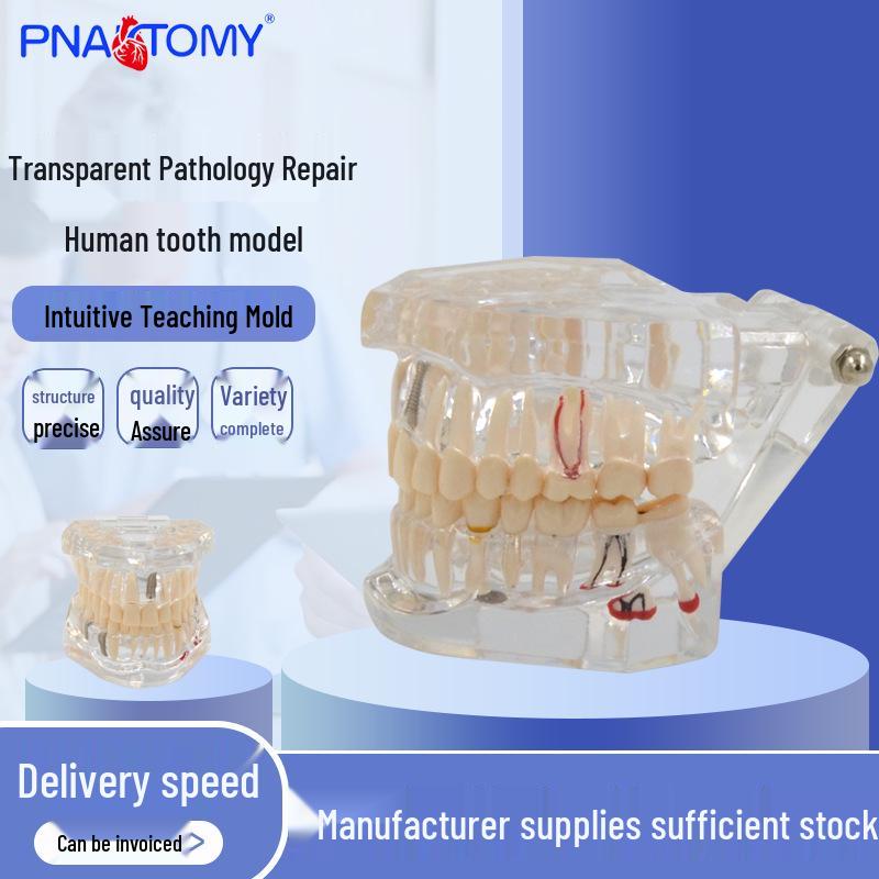 Transparent Pathological Restoration Dental Model - Human Tooth Model for Oral Cavity Study 7 x 9 x 6 cm